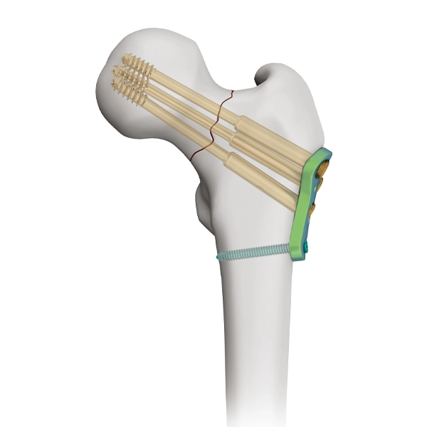Proximale femurvergrendelingsplaat voor gecanuleerde schroef van 7,3 mm