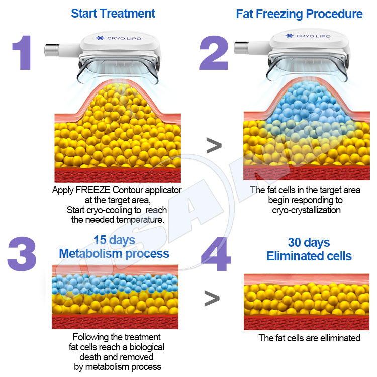 freezing fat procedure